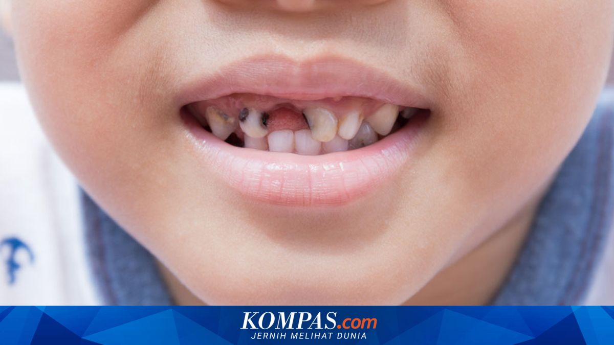 Kebiasaan Orangtua yang Dapat Menyebabkan Karies pada Gigi Anak