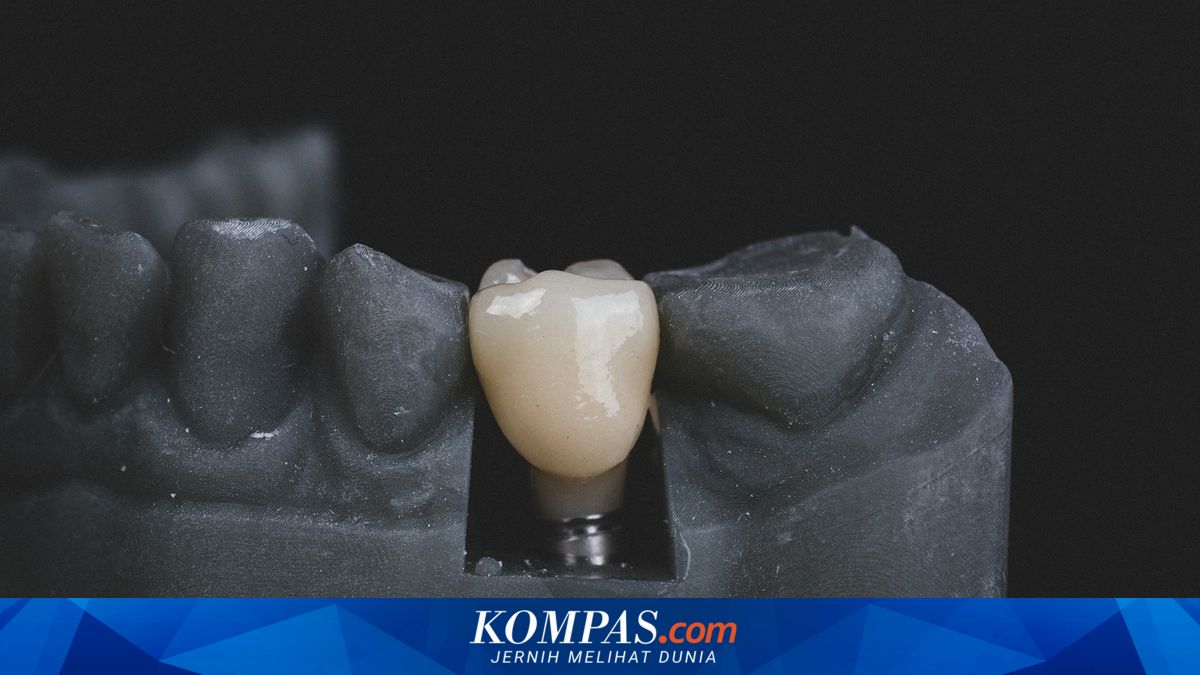 Implan Gigi: Solusi Efektif untuk Kembalikan Senyum dan Fungsi Mengunyah