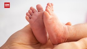 Peringatan Kesehatan Masyarakat: Waspada Campak saat Mudik Lebaran 2026