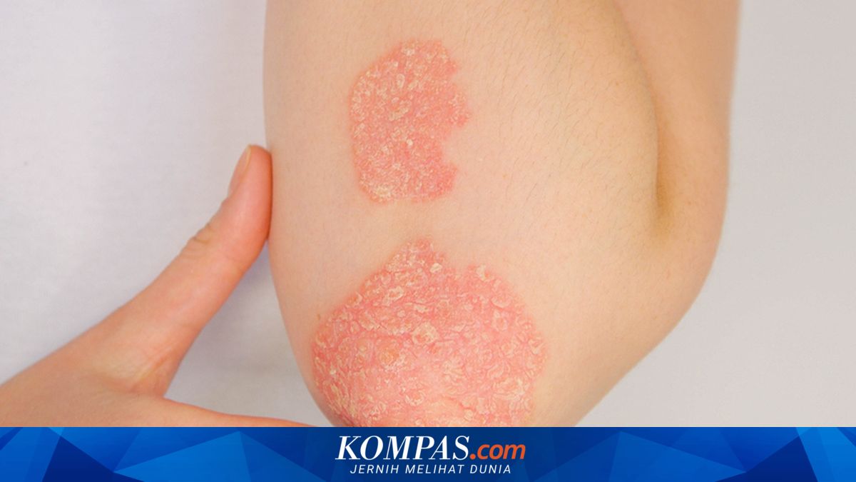 Pendekatan Microbiome dalam Penanganan Psoriasis: Studi Tunjukkan Peningkatan Hidrasi Kulit Signifikan