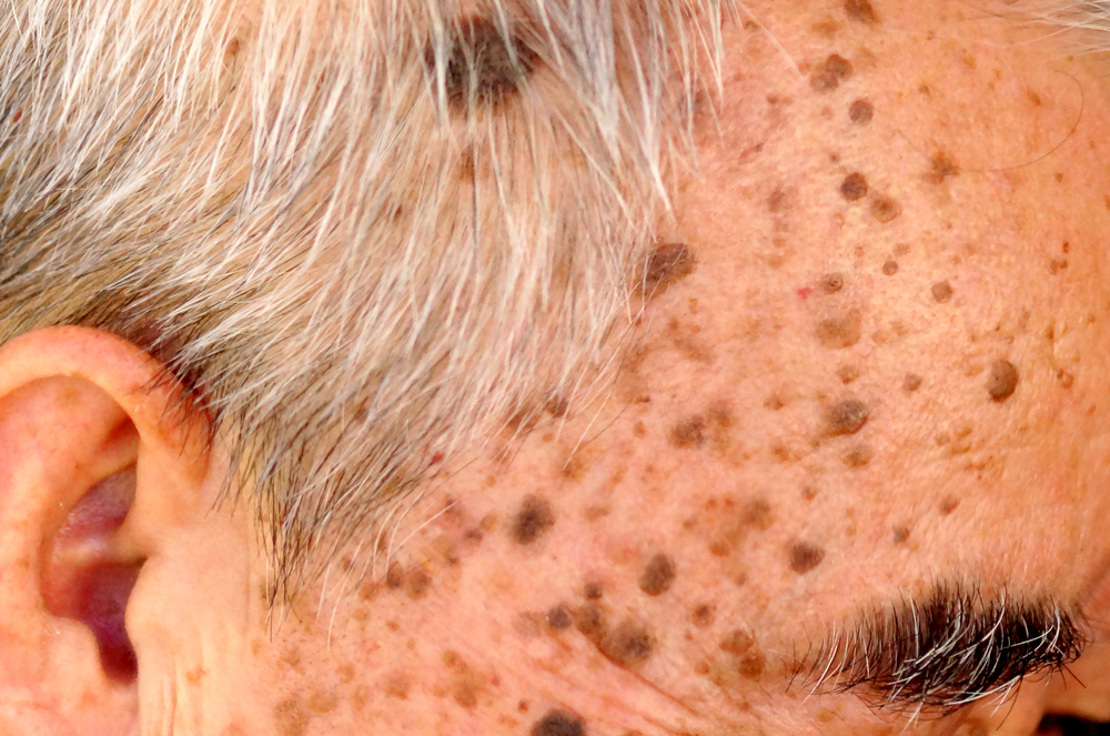 Mengenal Keratosis Seboroik: Bercak Kulit yang Sering Disalahartikan